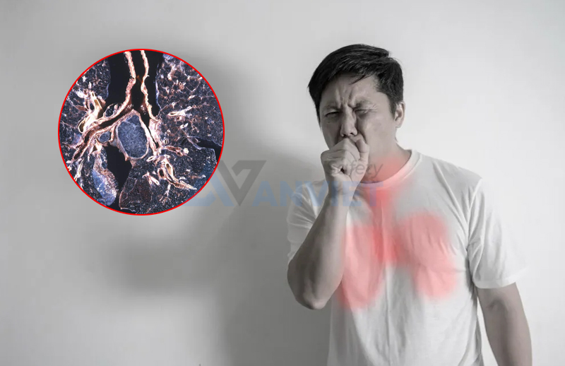 Tìm hiểu bệnh bụi phổi (Pneumoconiosis).